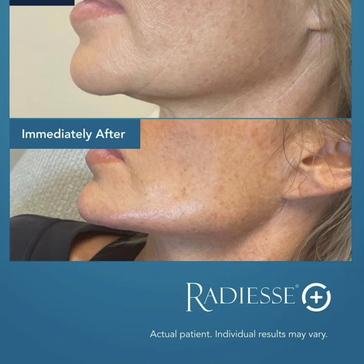 Tear Trough Filler Belfast