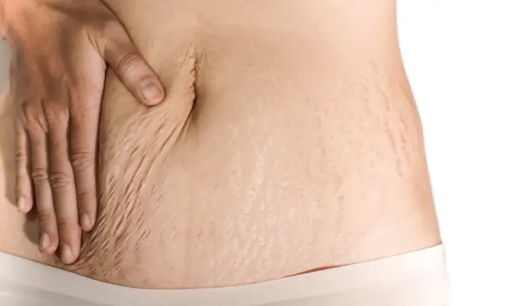 smokers lines treatment bangor