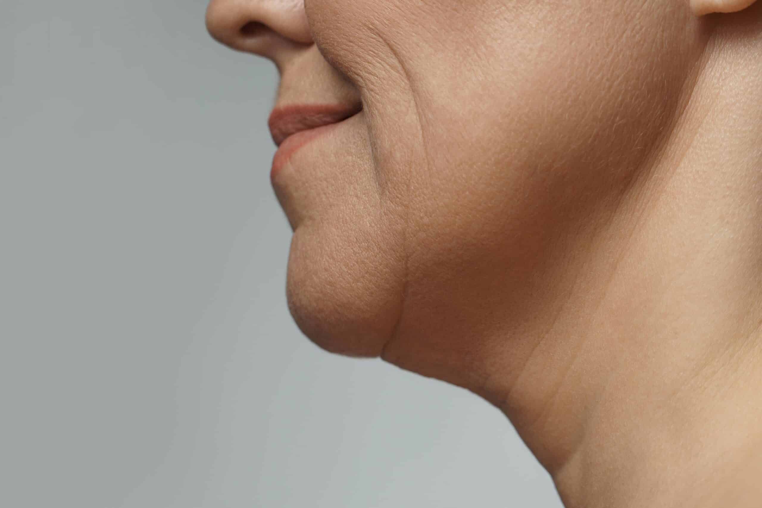 hyperpigmentation treatment bangor